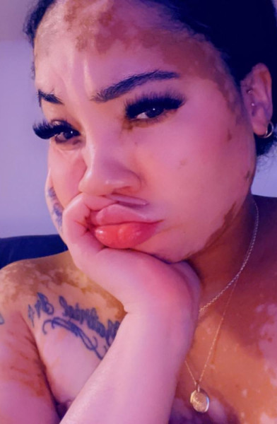 Vitiligo Bae